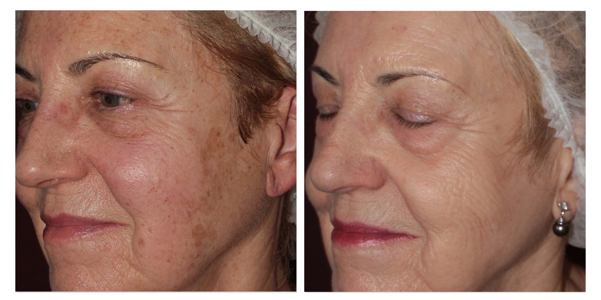 A Before And After Photo Of A Woman's Face — Aura Mediclinic In Ashmore, QLD