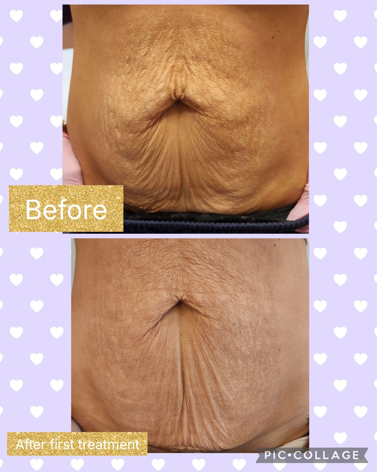 Comparison of a person's abdomen before and after treatment, showing reduction in skin folds and texture.