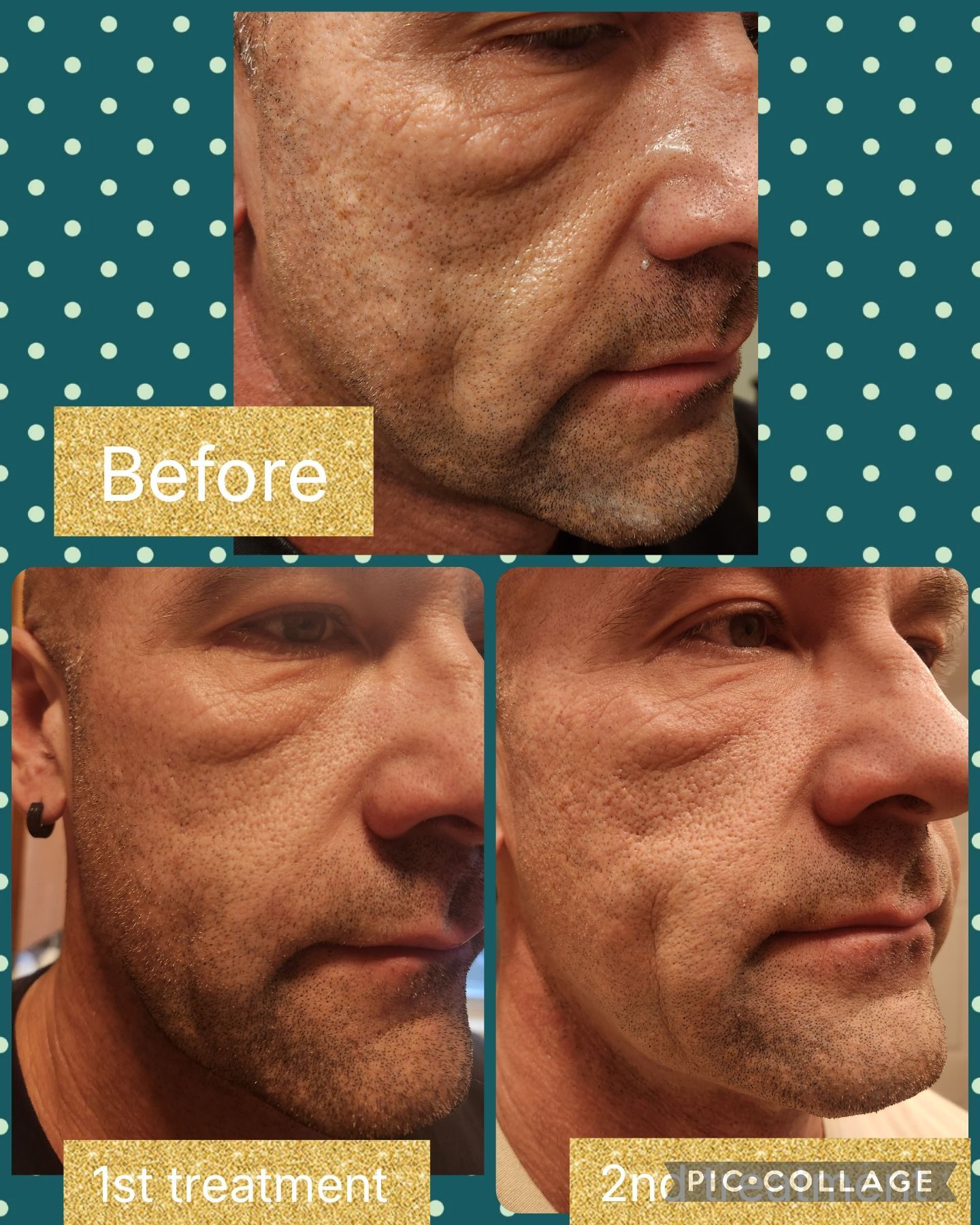 Collage showing a man's face before and after treatments. Wrinkles appear reduced.
