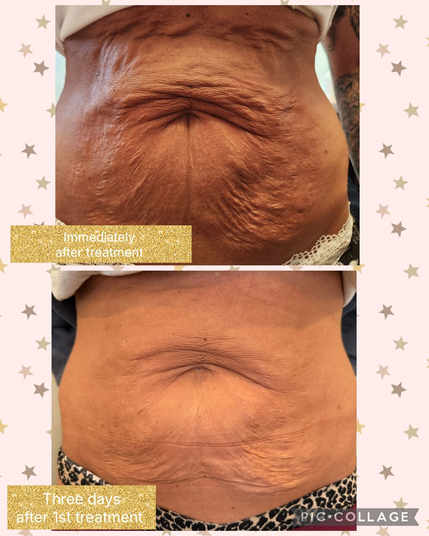 Comparison of a person's abdomen before and after treatment, showing changes in skin texture.