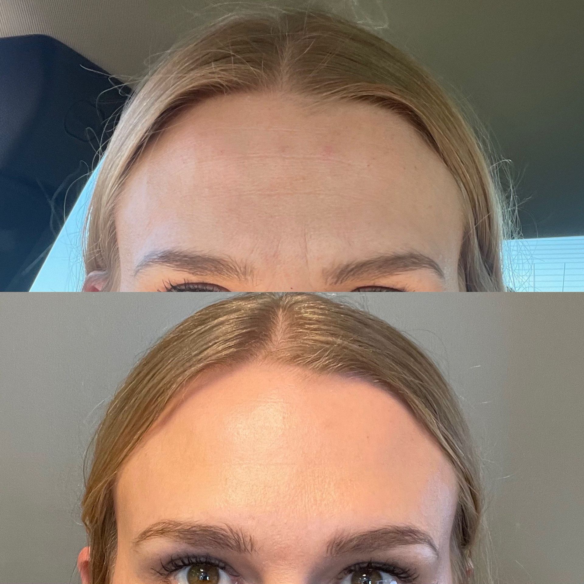 A before and after photo of a woman 's forehead.