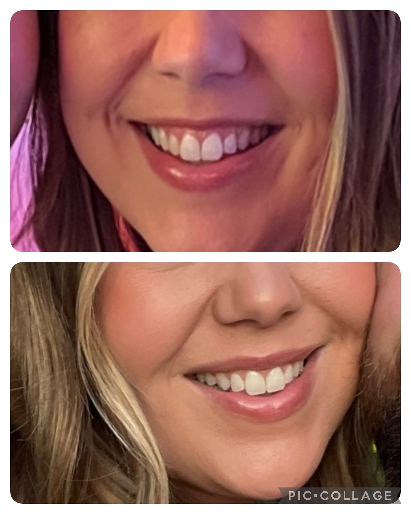 A before and after picture of a woman 's smile