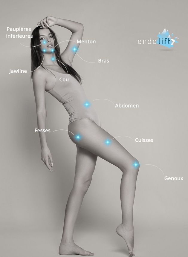 endolift zone ou le traitement est possiblr