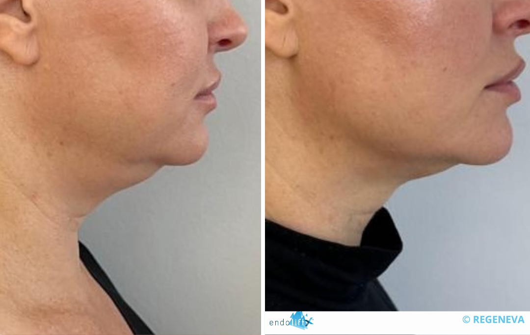 endolift rouen avant apres