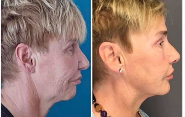 endolift rouen avant apres