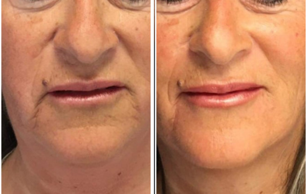 endolift rouen avant apres