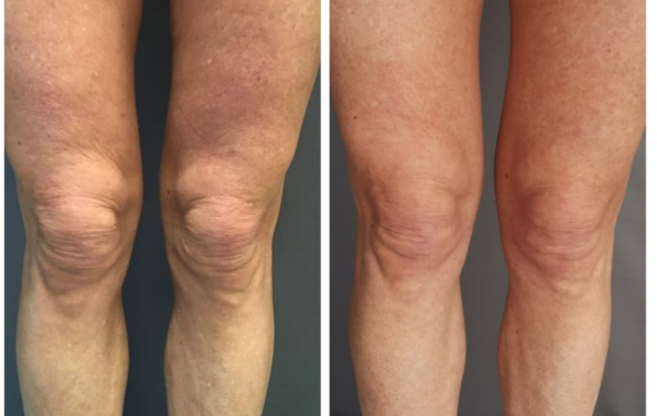 endolift rouen avant apres