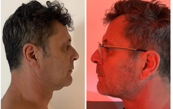 endolift rouen avant apres