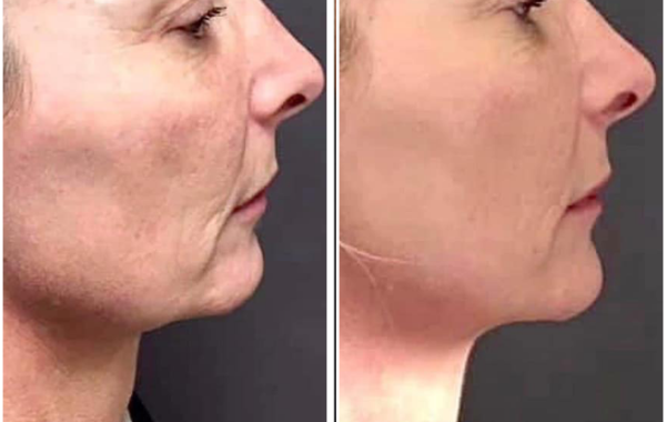 endolift rouen avant apres