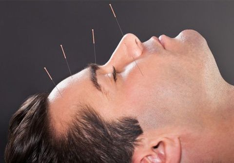 Acupuncture treatments