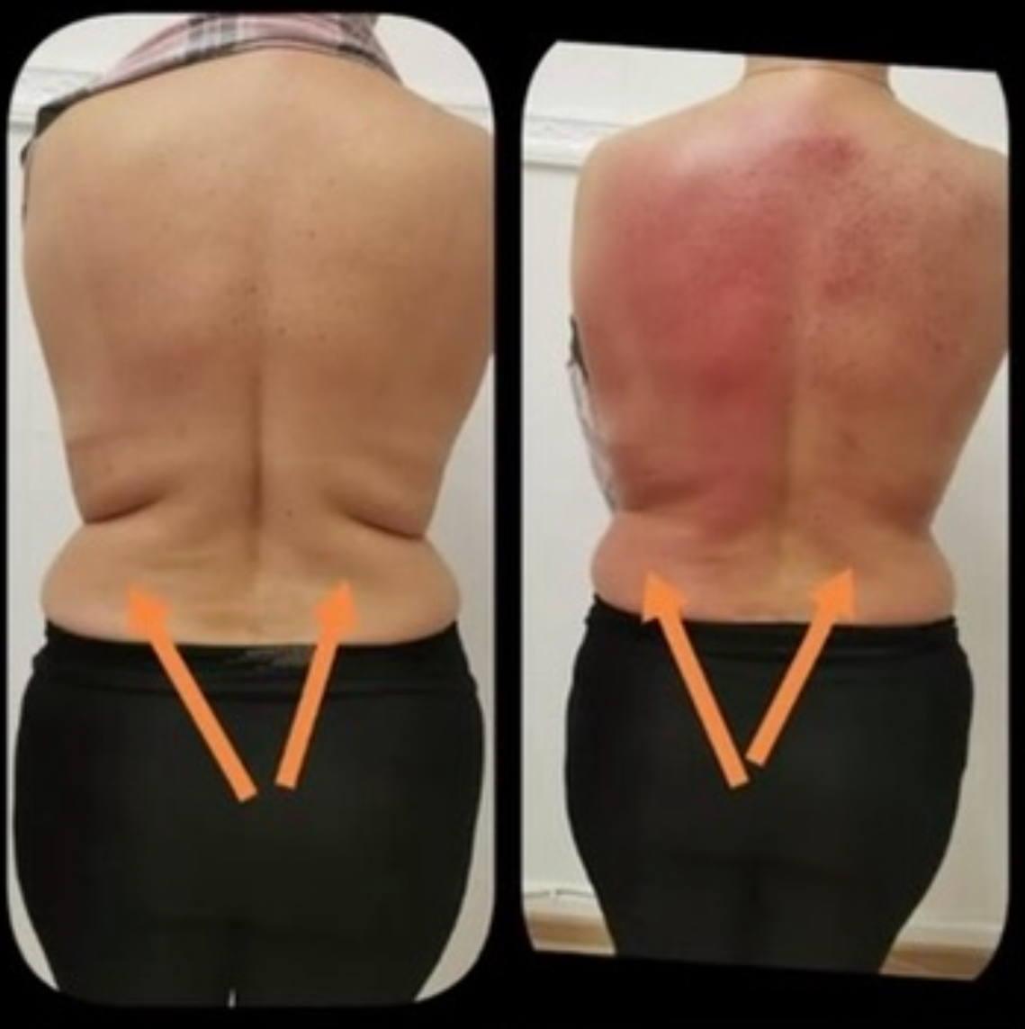 An Artemis T-Shape 2 before and after of a woman's back.
