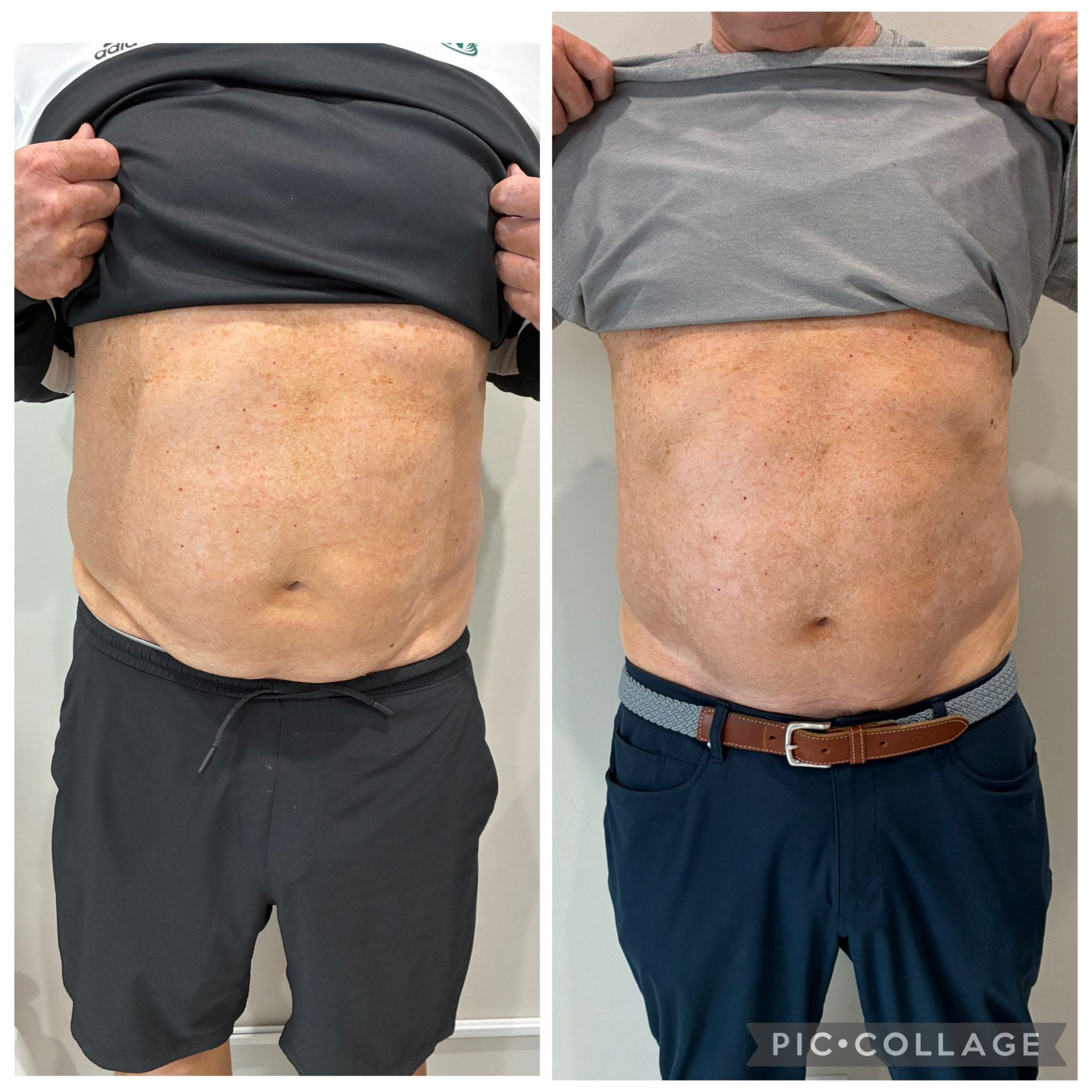 An Artemis T-Shape 2 before and after of a man's midsection.