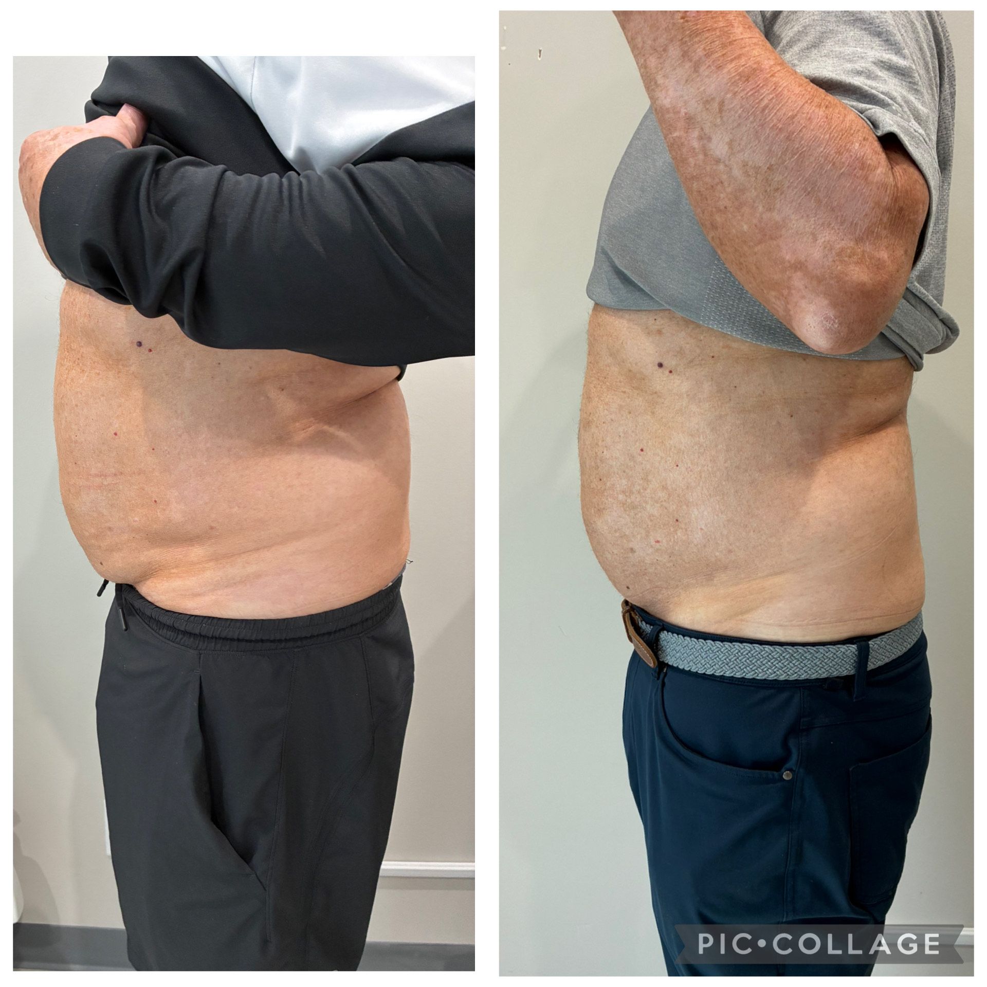An Artemis T-Shape 2 before and after of a man's midsection.
