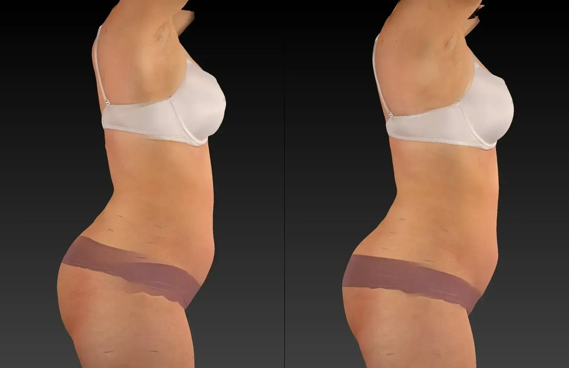 Two side-view renderings of a body in underwear, before and after a procedure.