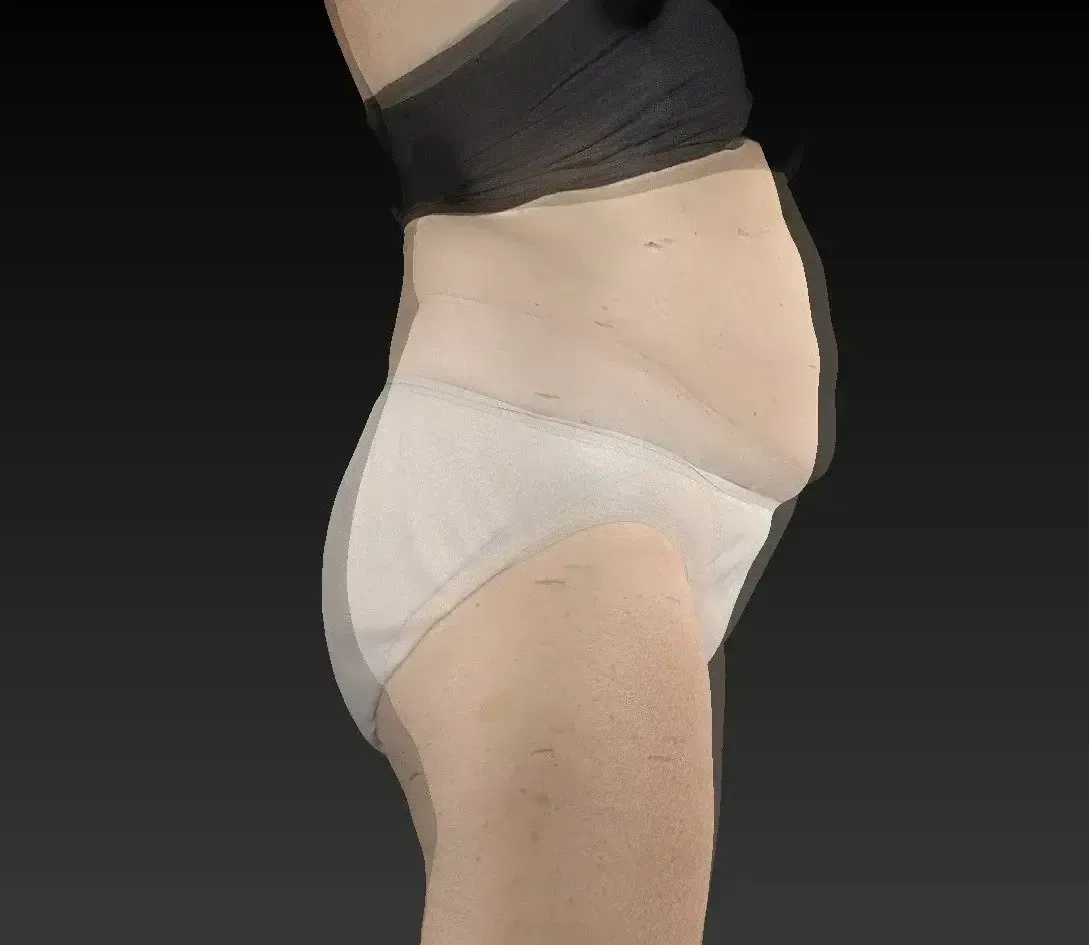 Side view of torso and hips. A person is wearing a black bra, tan underwear, and an abdomen support garment.
