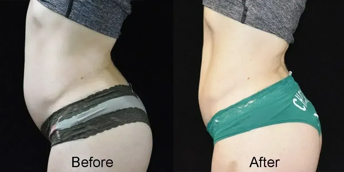 Side-by-side comparison of a person's abdomen, labeled 