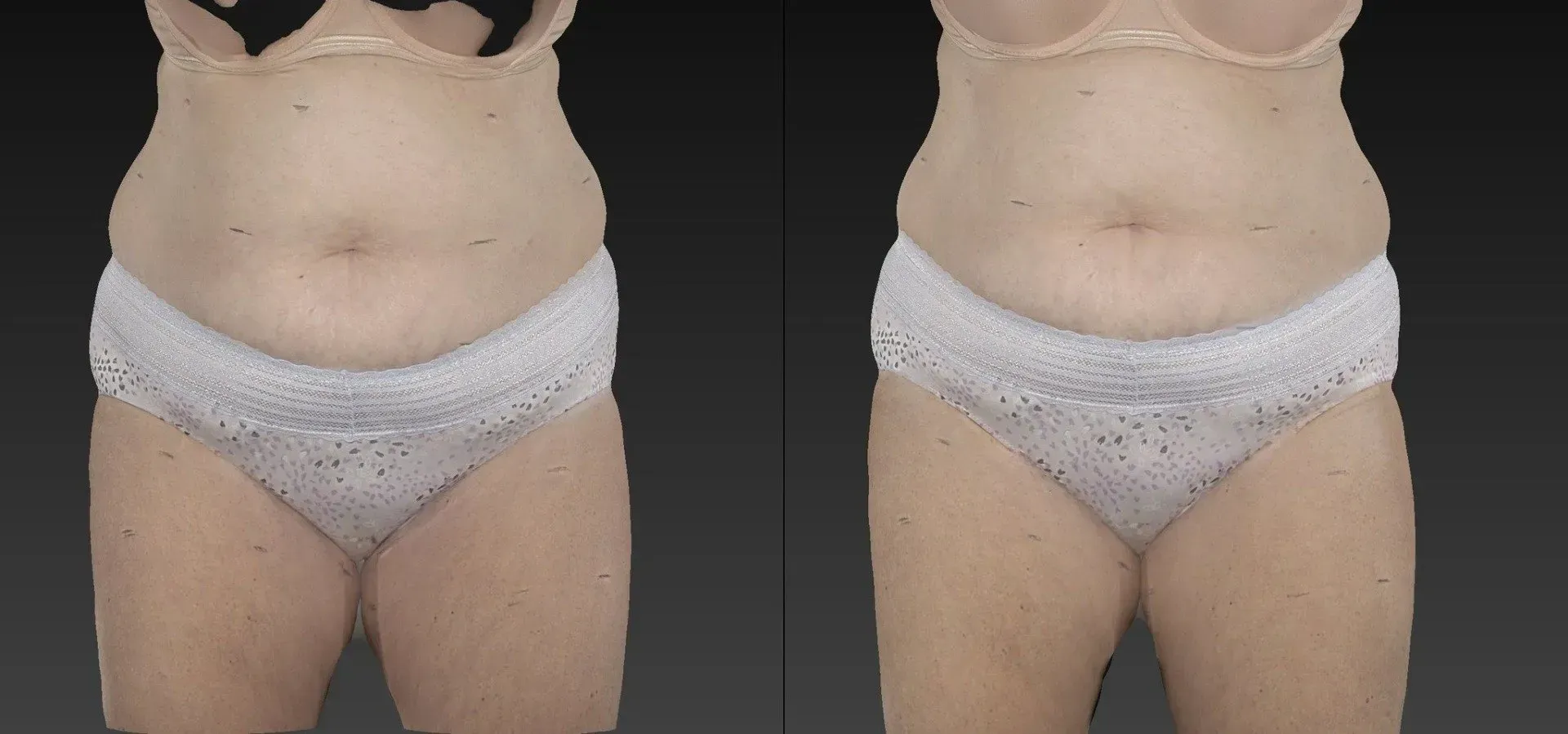 Two torso scans side-by-side, showing midriff in underwear and bra. Gray background.