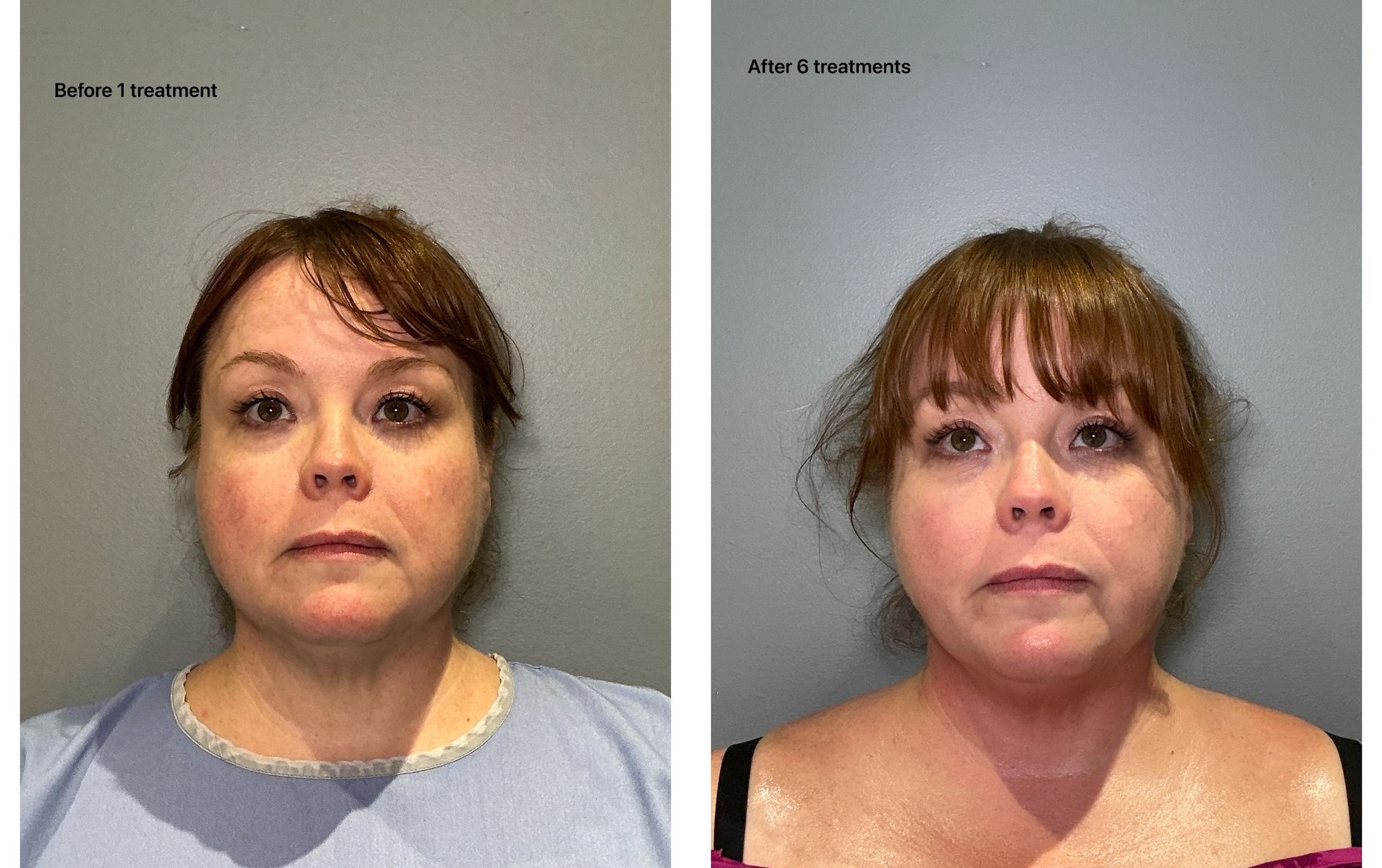 An Artemis T-Shape 2 before and after of a woman's face.