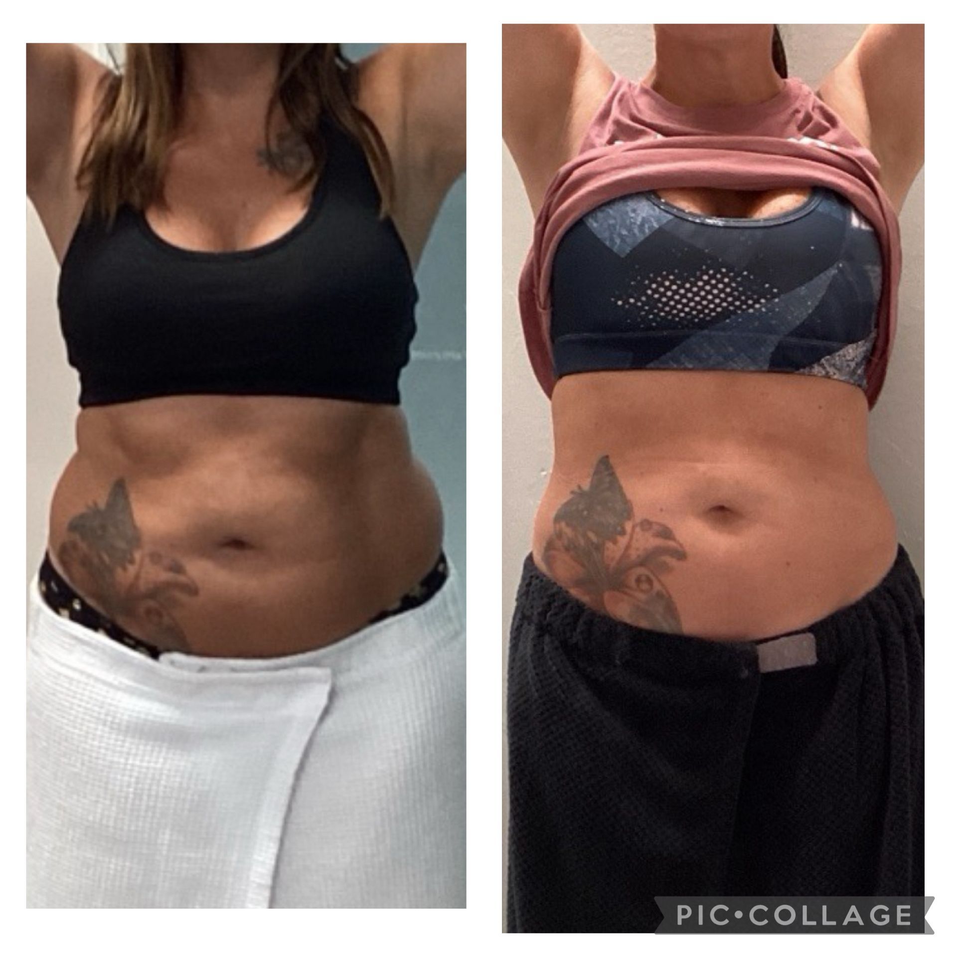 An Artemis T-Shape 2 before and after of a woman's midsection.