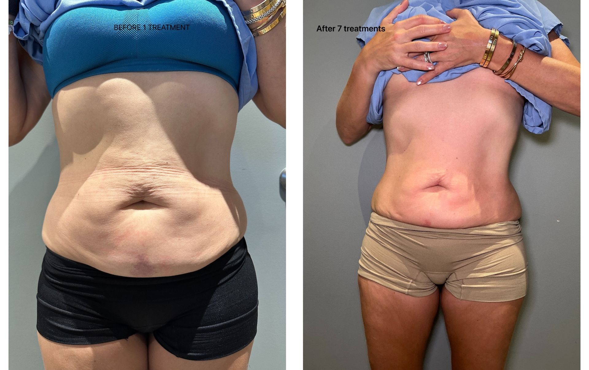 An Artemis T-Shape 2 before and after of a woman's belly.