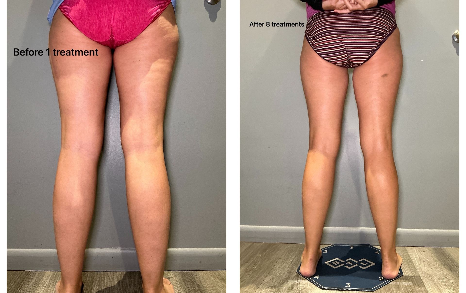 An Artemis T-Shape 2 before and after of a woman's legs.