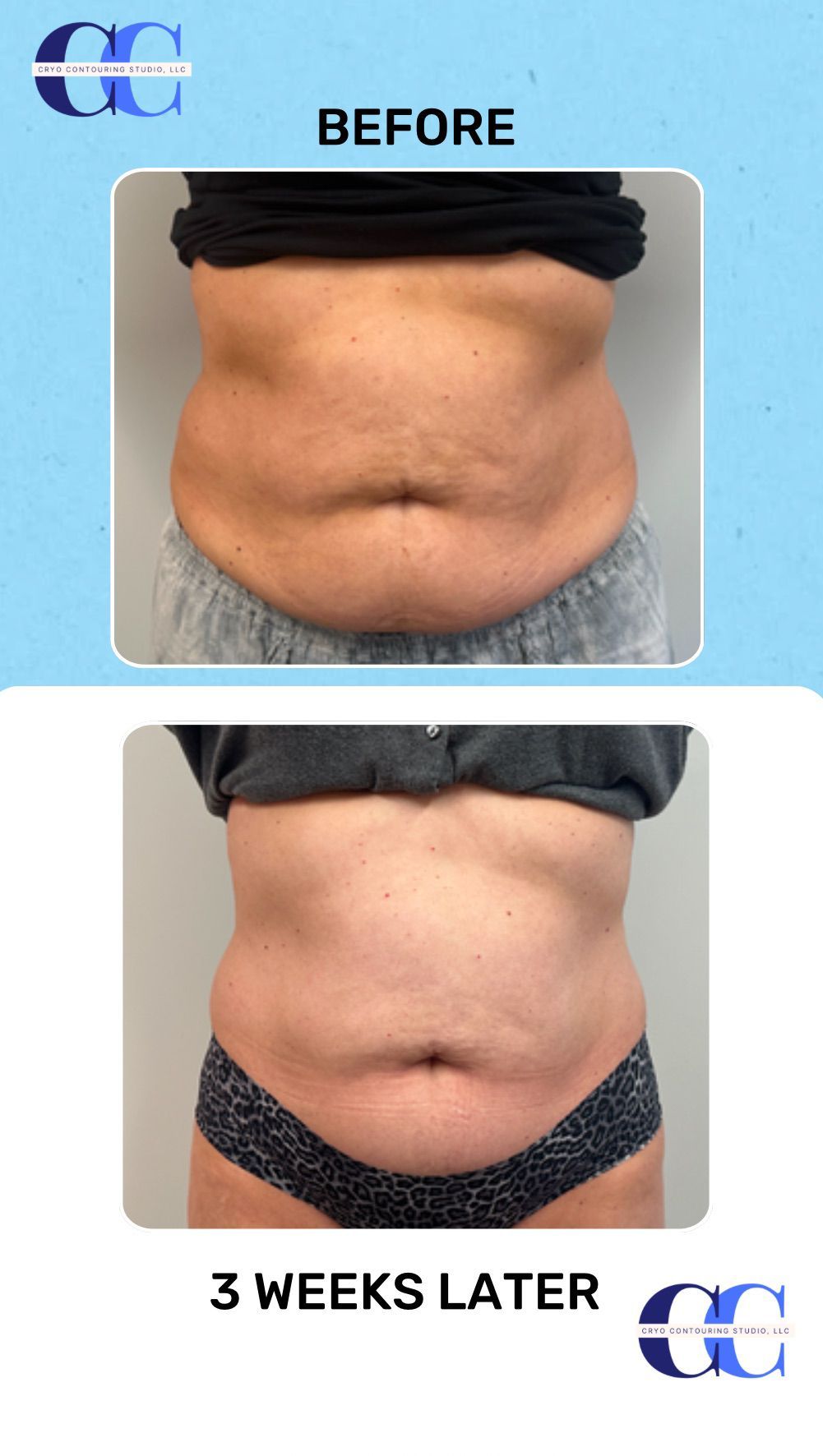 An Artemis T-Shape 2 before and after of a woman's midsection.