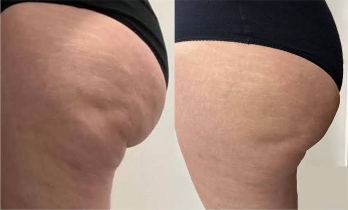 An Artemis T-Shape 2 before and after of a woman's glutes.