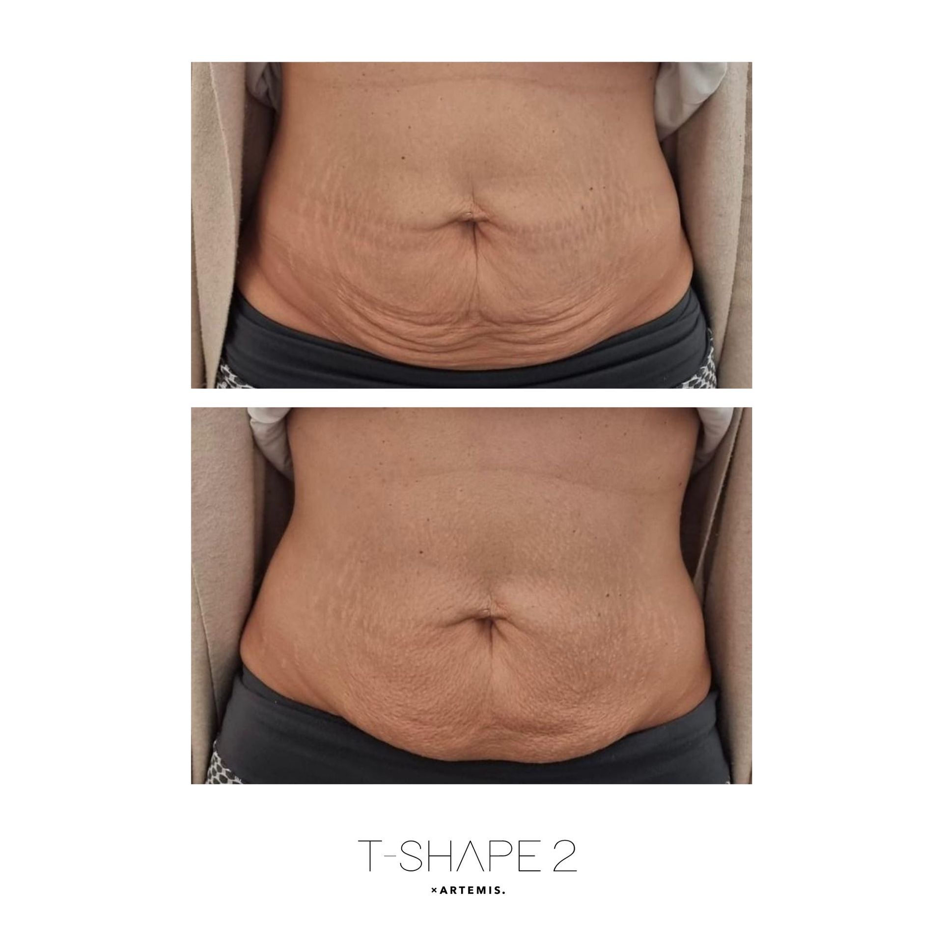 An Artemis T-Shape 2 before and after of a woman's belly.
