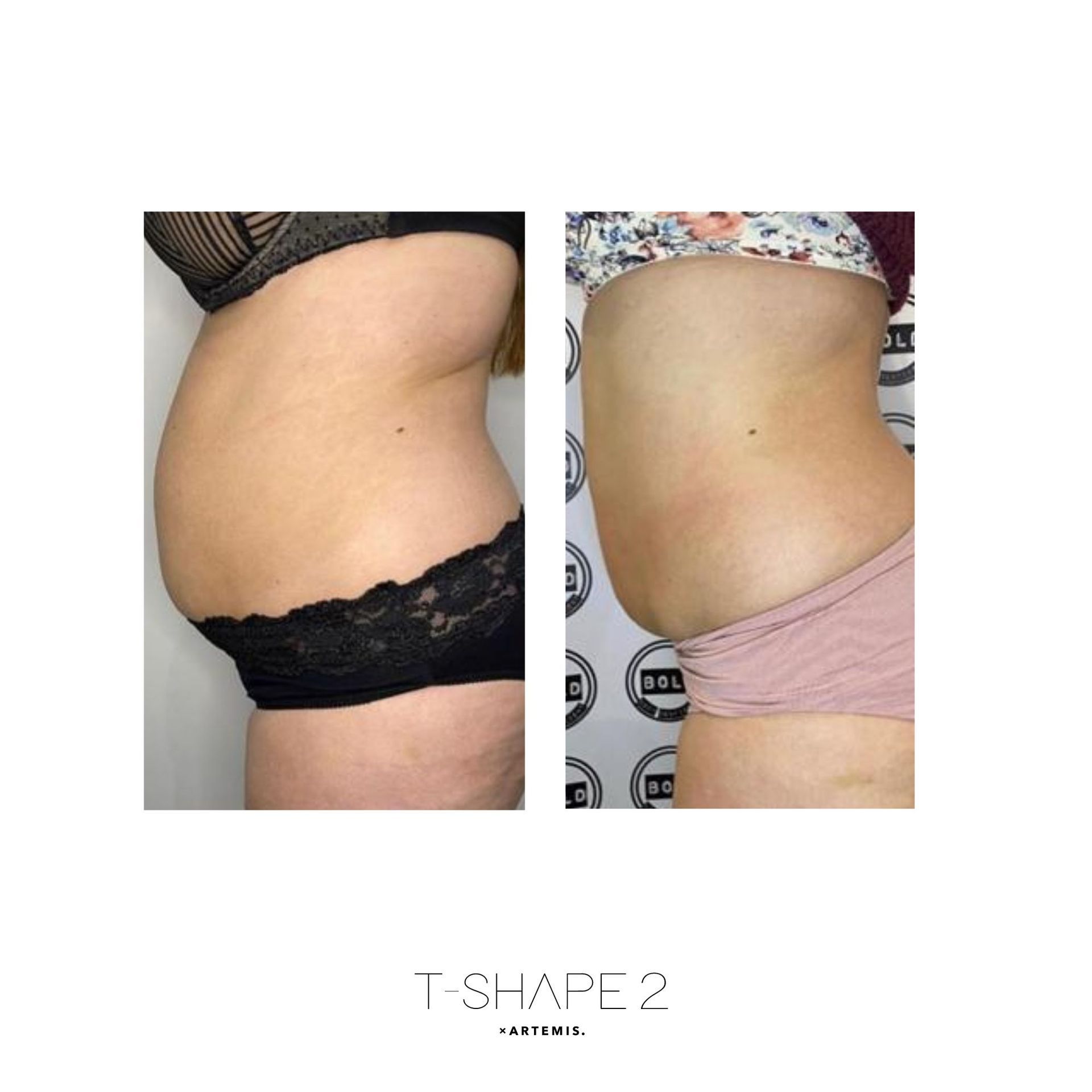 An Artemis T-Shape 2 before and after of a woman's belly.