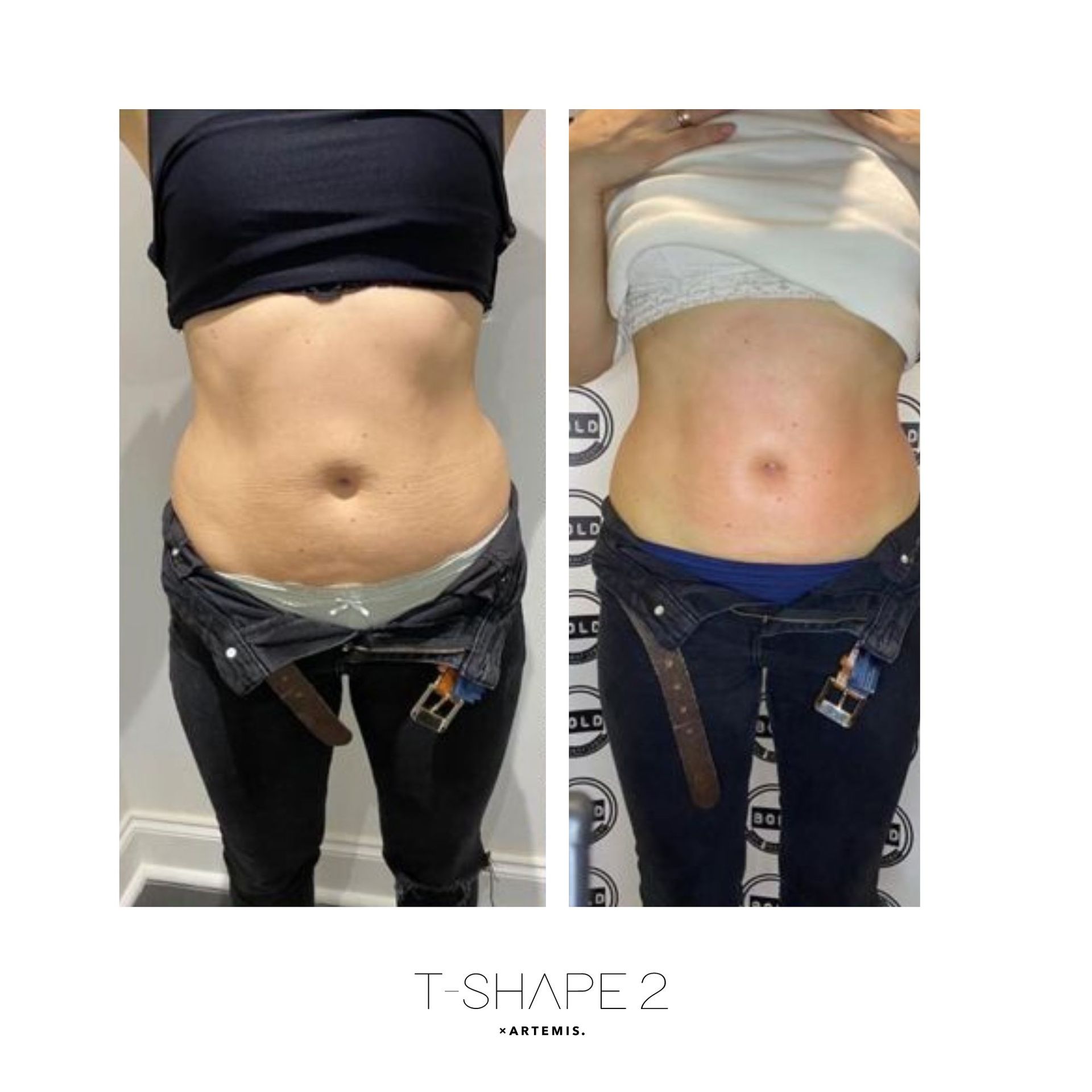 An Artemis T-Shape 2 before and after of a woman's belly.