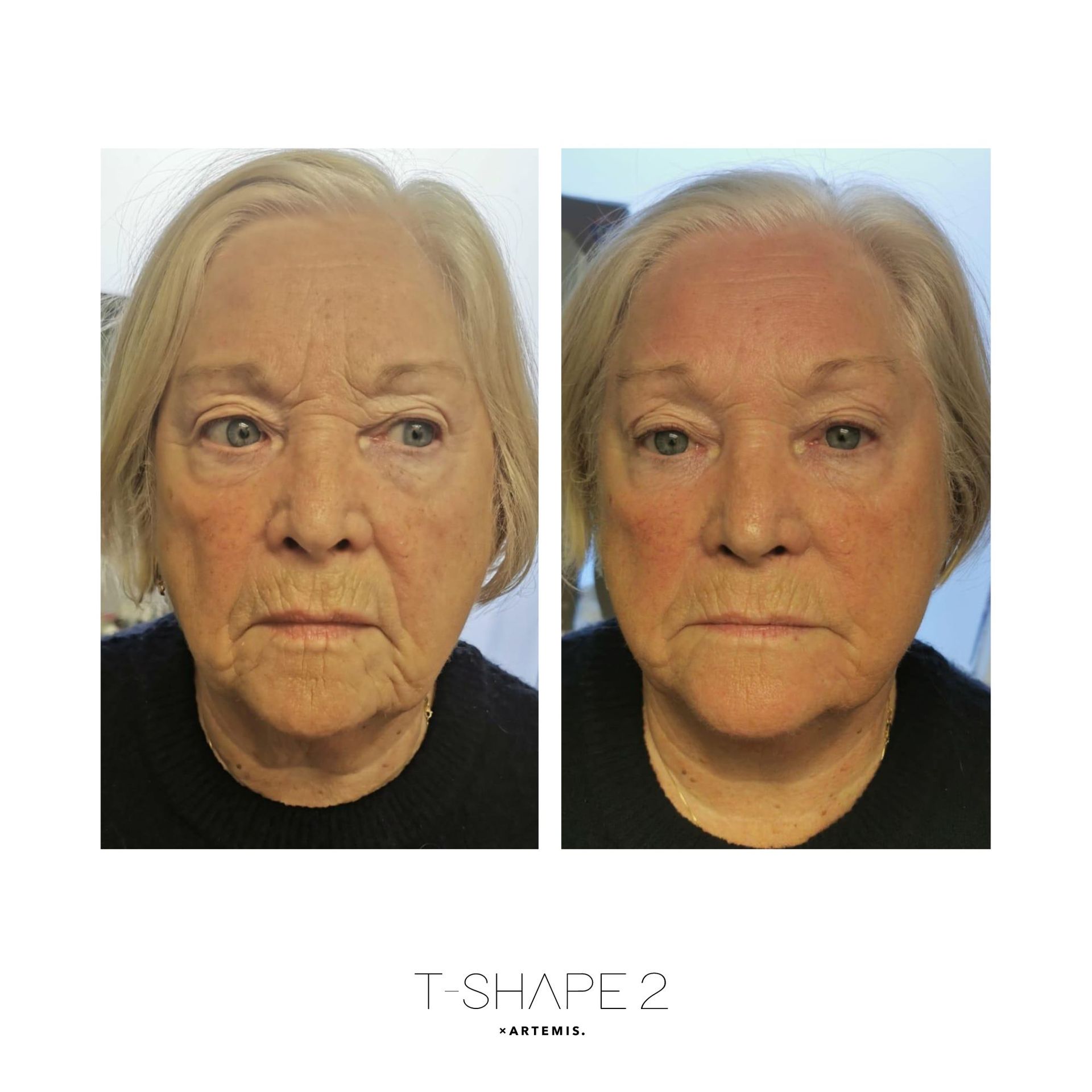 An Artemis T-Shape 2 before and after of a woman's face.