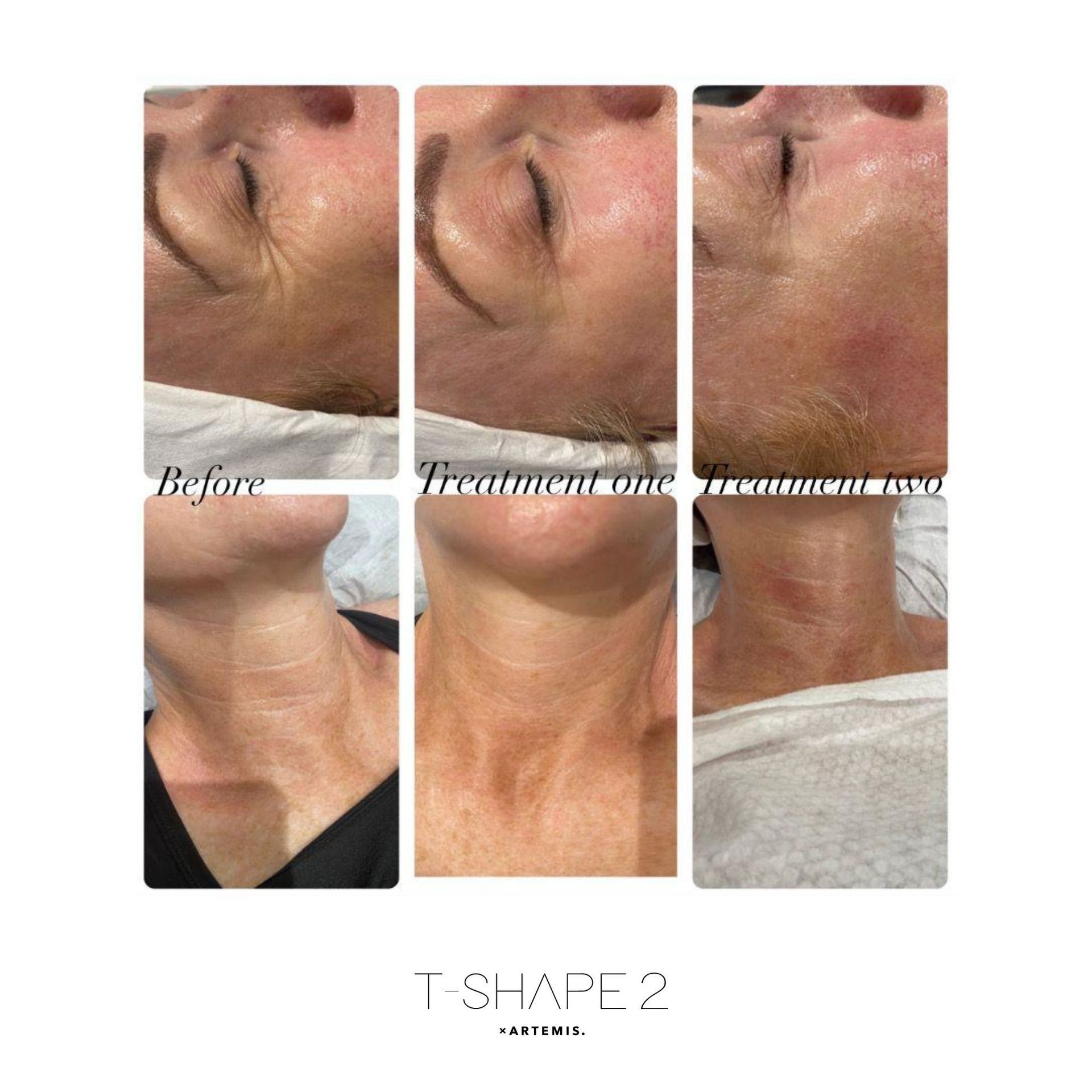 An Artemis T-Shape 2 before and after of a woman's face.