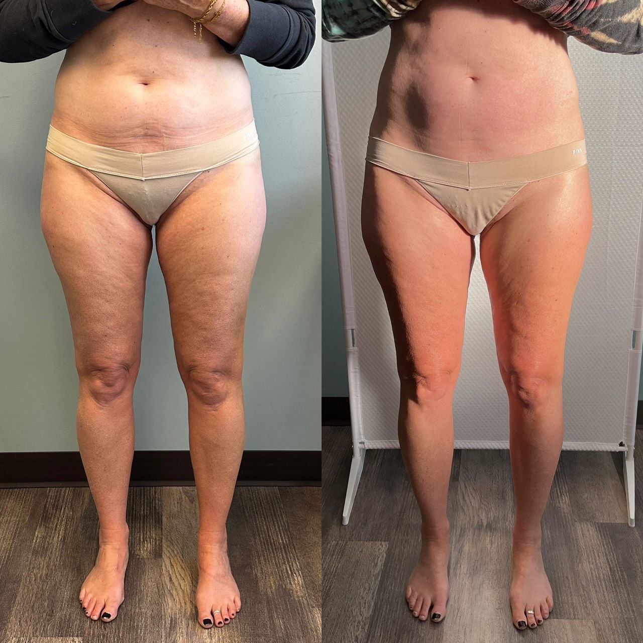 An Artemis T-Shape 2 before and after of a woman's belly and legs.
