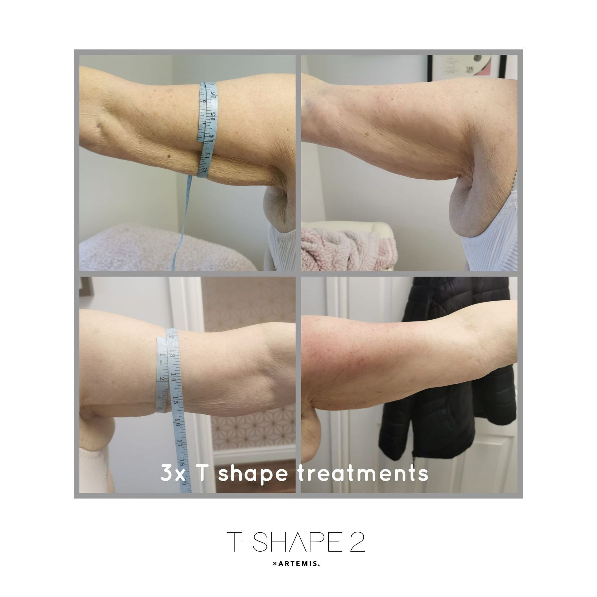 An Artemis T-Shape 2 before and after of a woman's arms.
