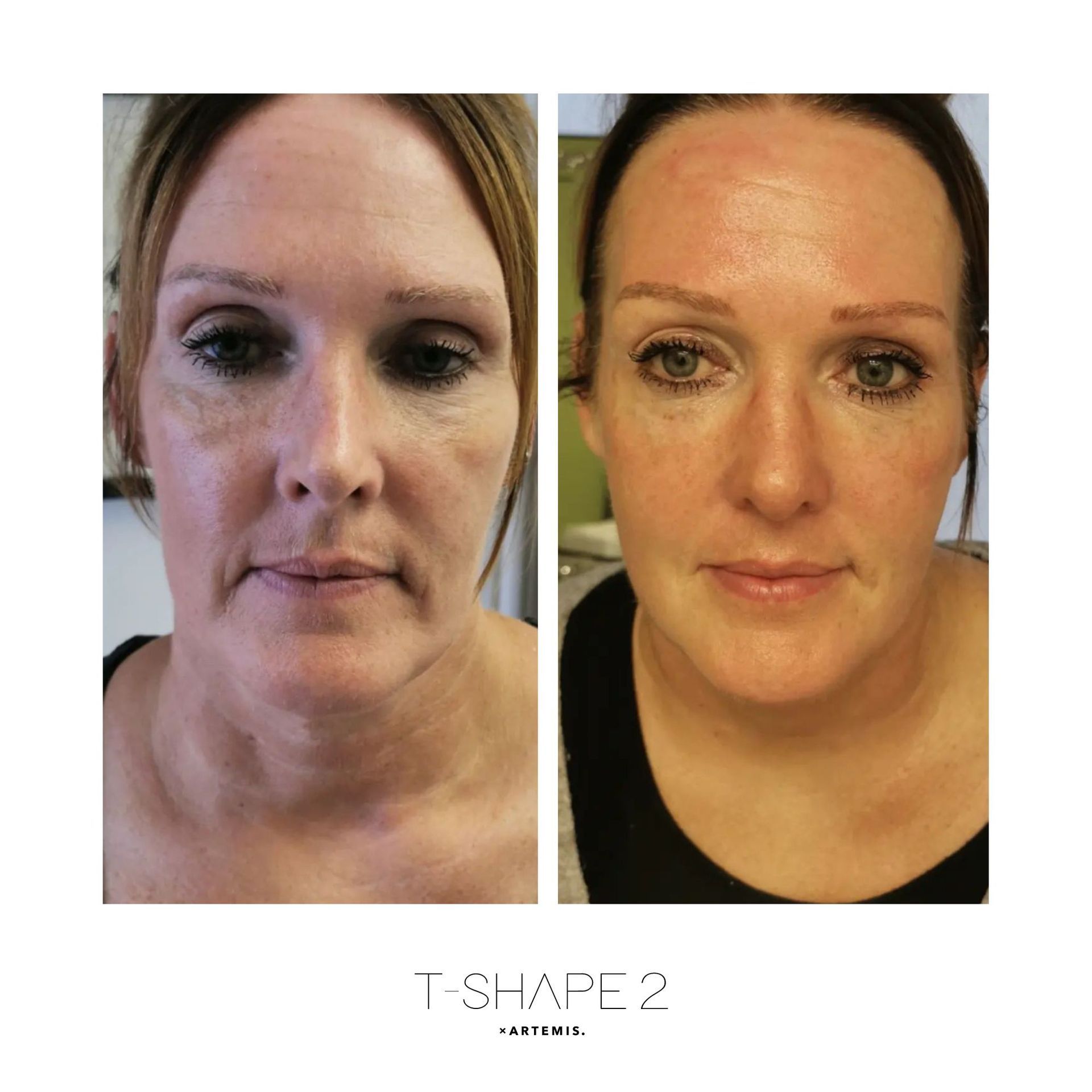 An Artemis T-Shape 2 before and after of a woman's face.
