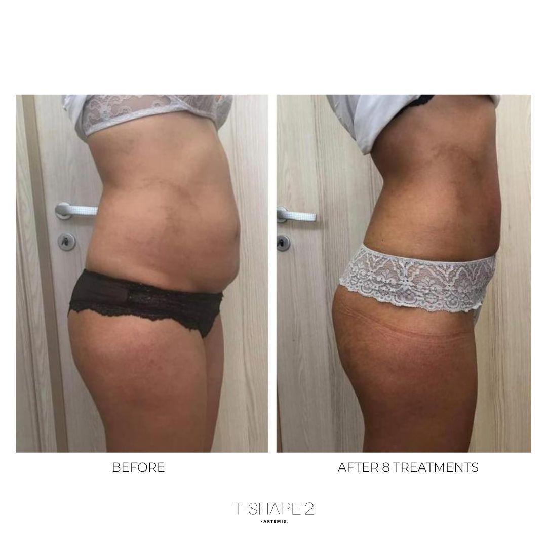 An Artemis T-Shape 2 before and after of a woman's belly and legs.