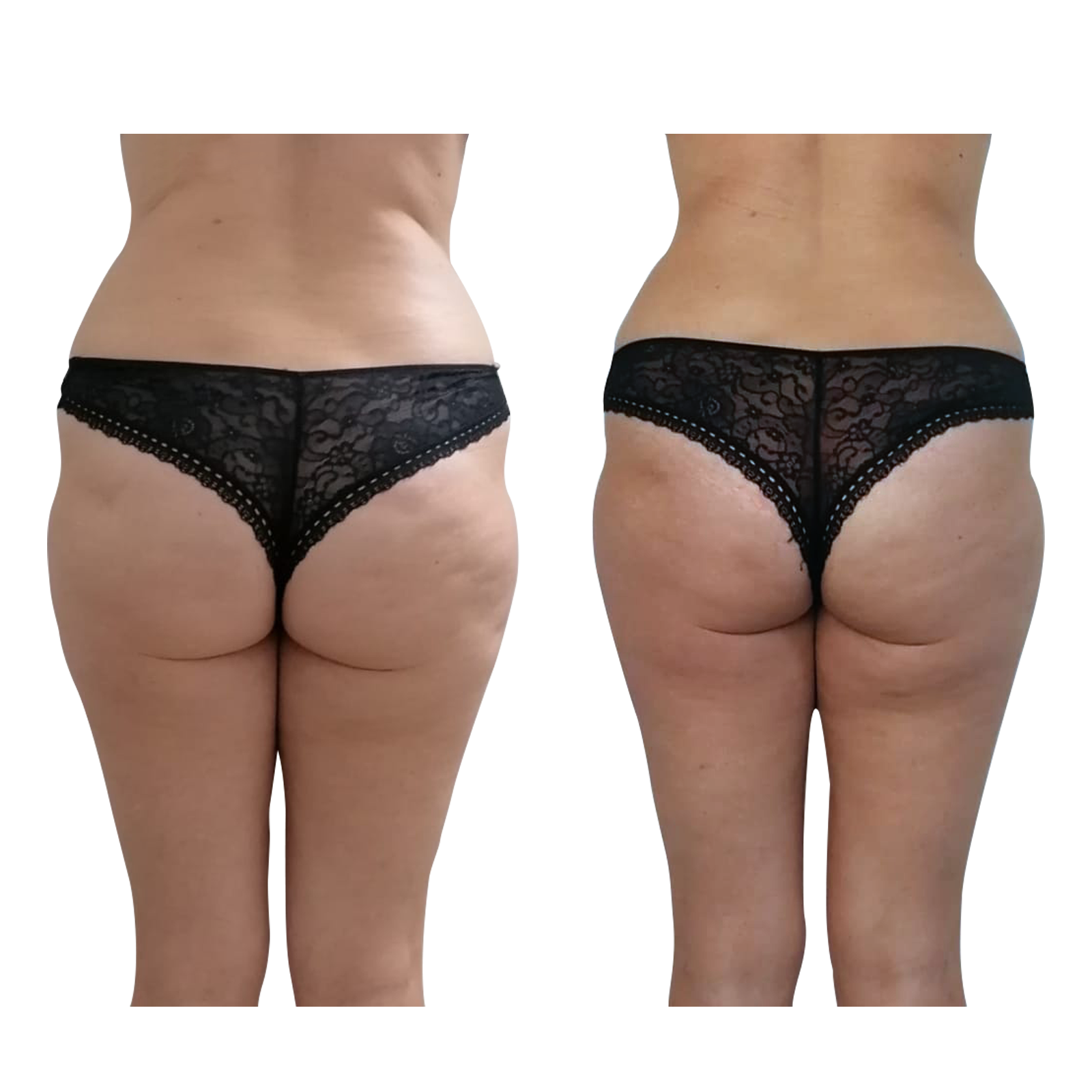 An Artemis T-Shape 2 before and after of a woman's back and glutes.