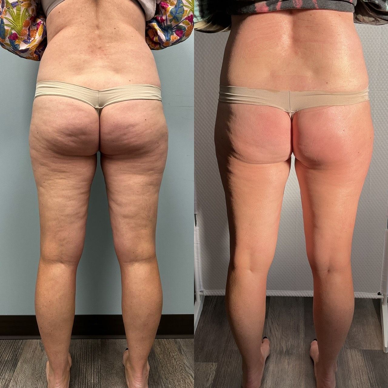 Side-by-side back views of a person in underwear, showing before-and-after body contour changes.