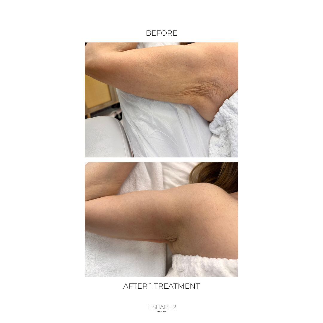 An Artemis T-Shape 2 before and after photo of a woman's arm.