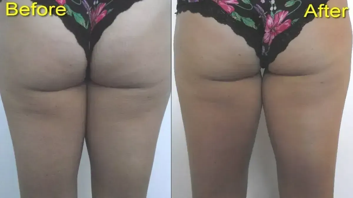 Side-by-side comparison of buttocks; the 