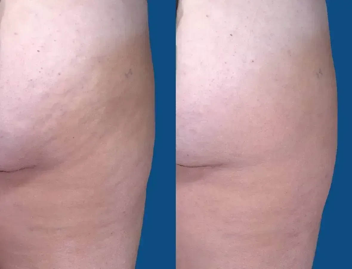 Before and after view of a thigh showing the reduction of stretch marks. The right side appears smoother.