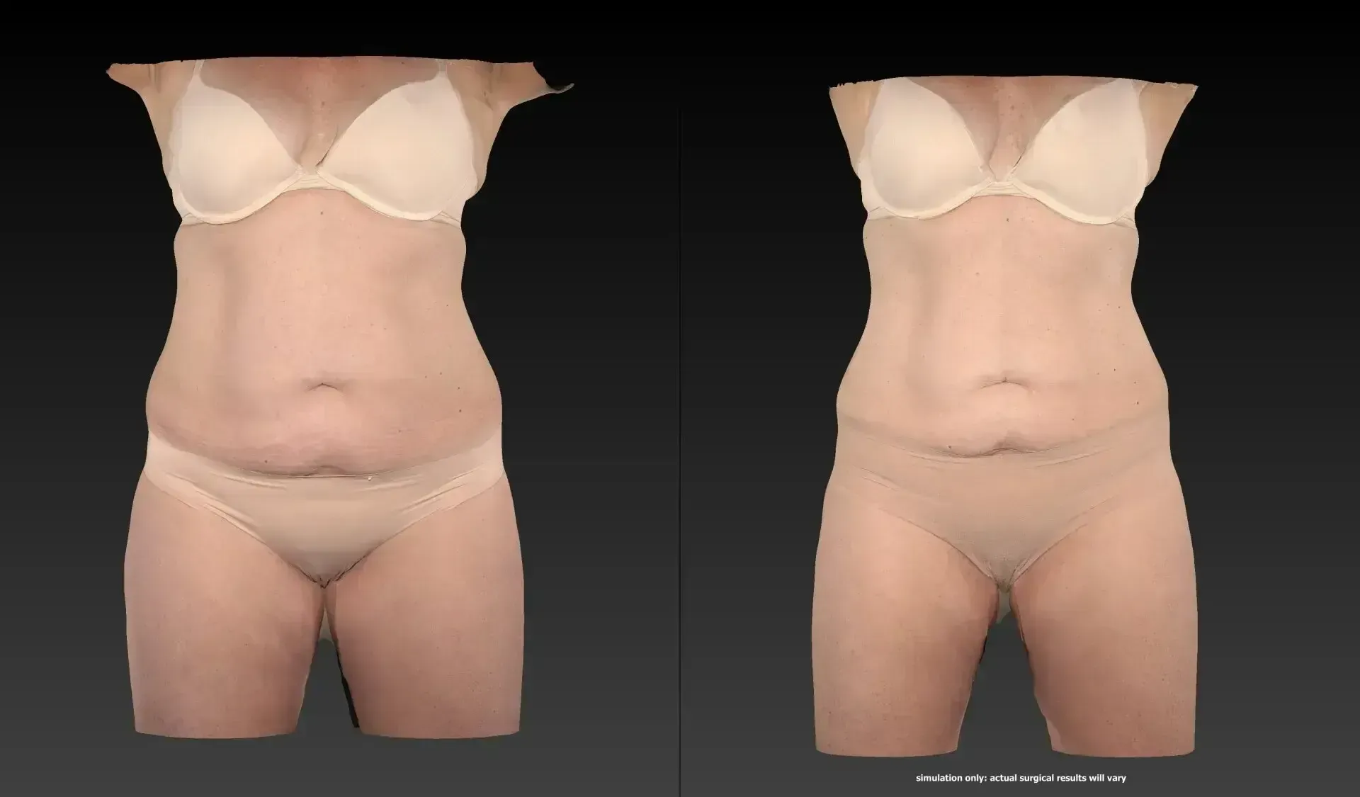 Side-by-side comparison of a person's torso, before and after, wearing underwear and a bra; showing changes in appearance.
