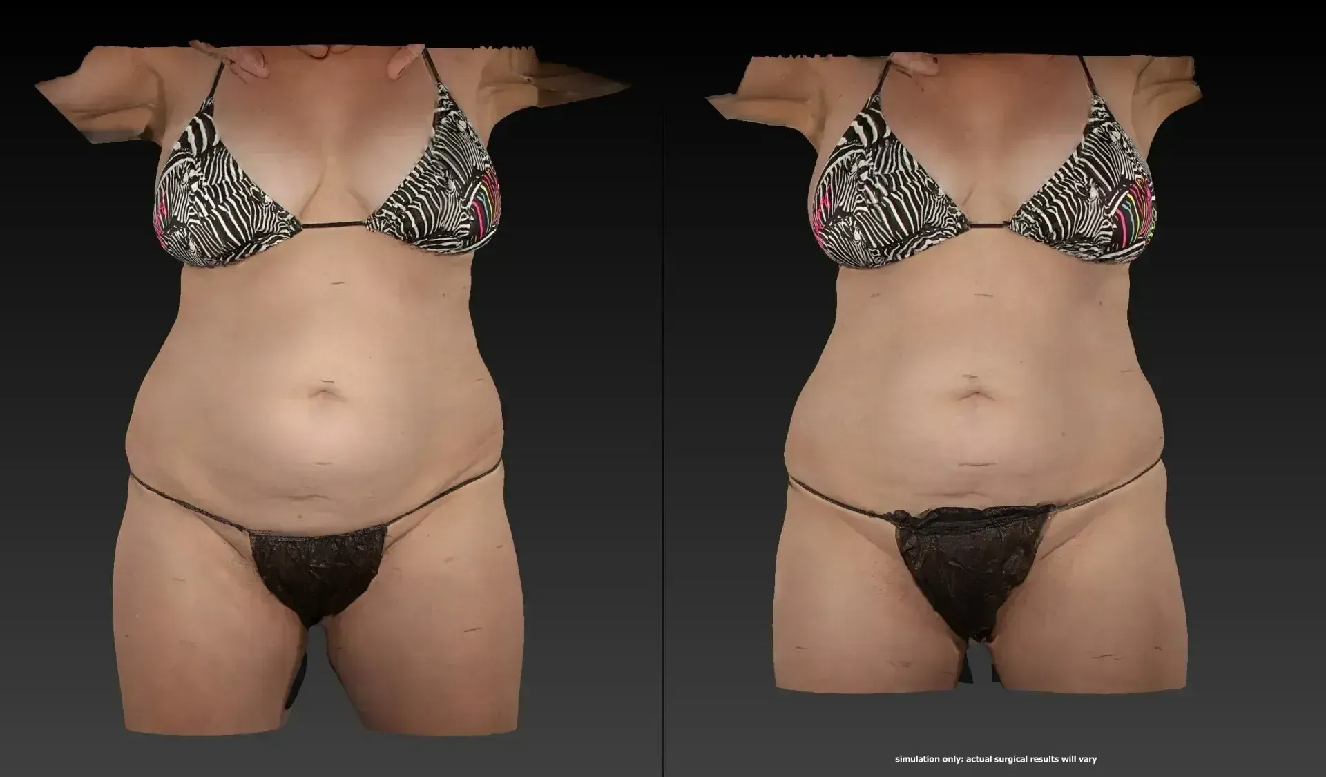 Side-by-side view of a torso in a bikini. The left side appears before, and the right appears after a procedure.