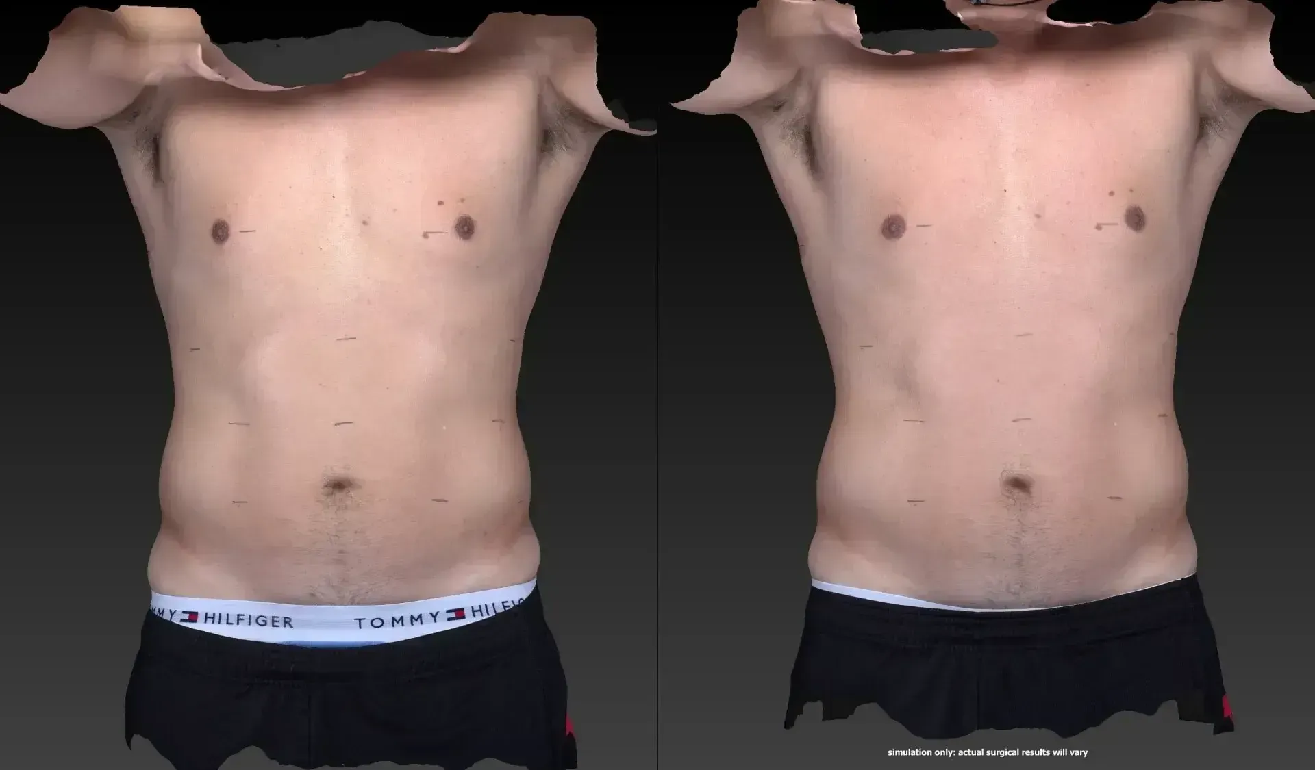 Two torso views: front of a person in underwear. The left has a slightly larger abdomen.