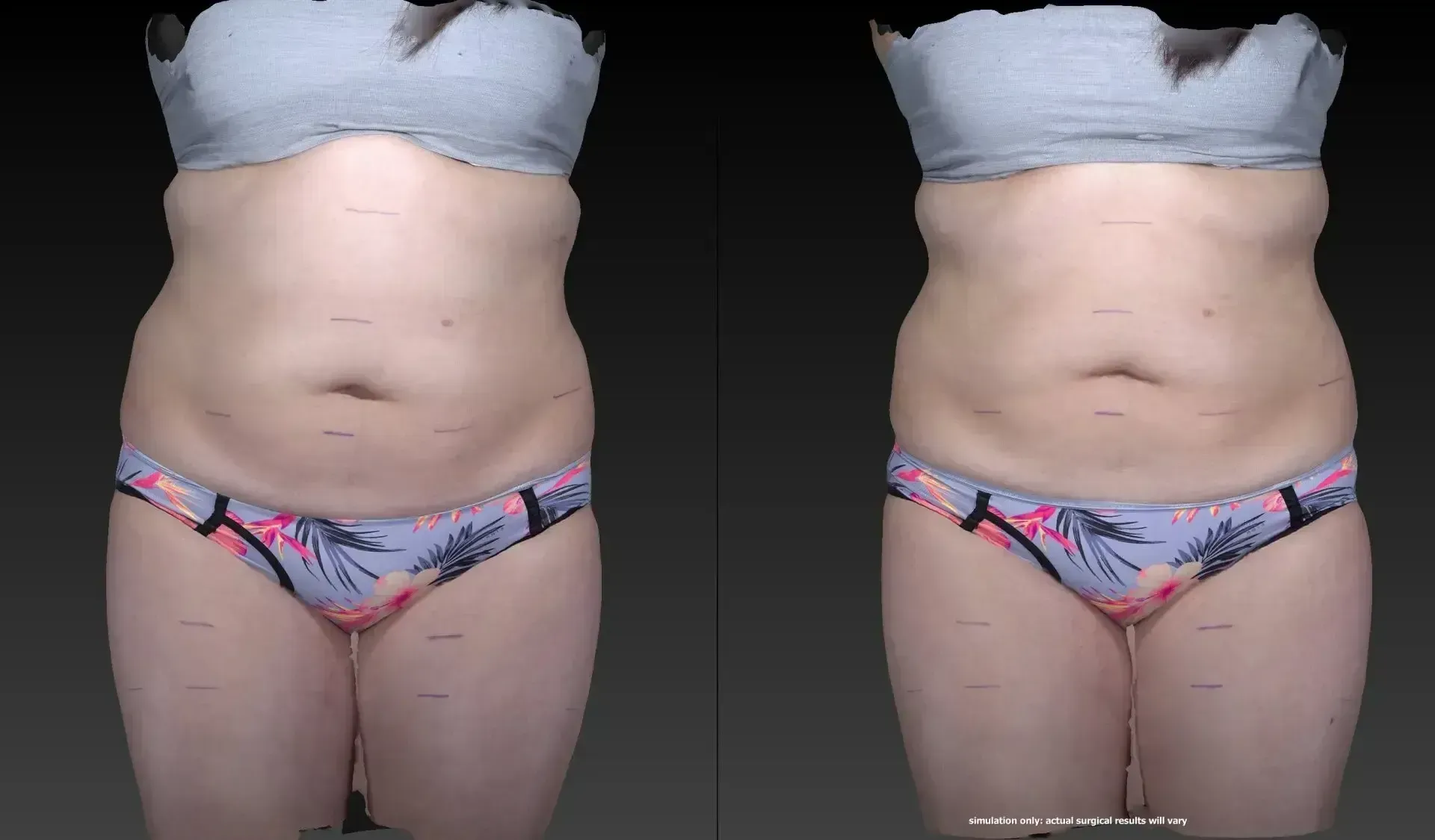 Two frontal views of a person in lingerie; comparison of before and after treatment, focusing on the abdomen.