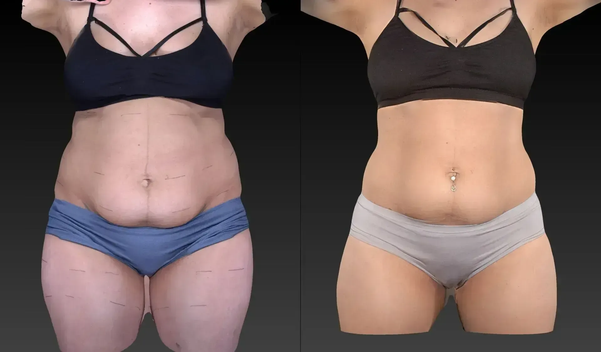 Side-by-side torso view of a person wearing lingerie. The left side shows before results, the right side after.