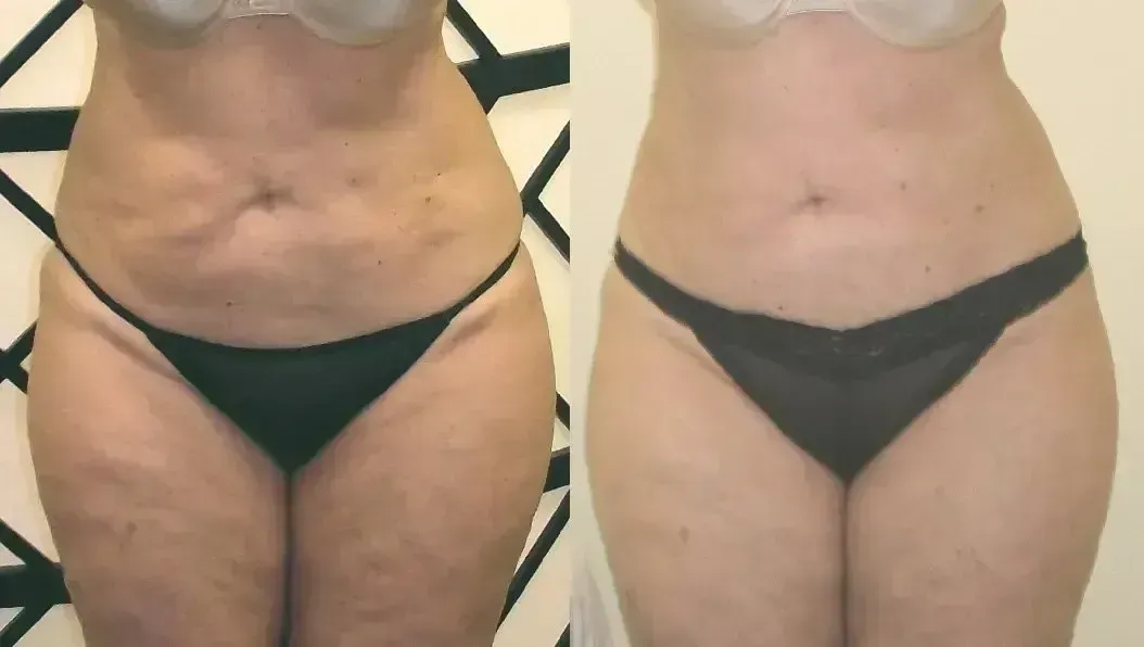 Before and after frontal view of a person's torso. Skin appears smoother, with less visible cellulite.
