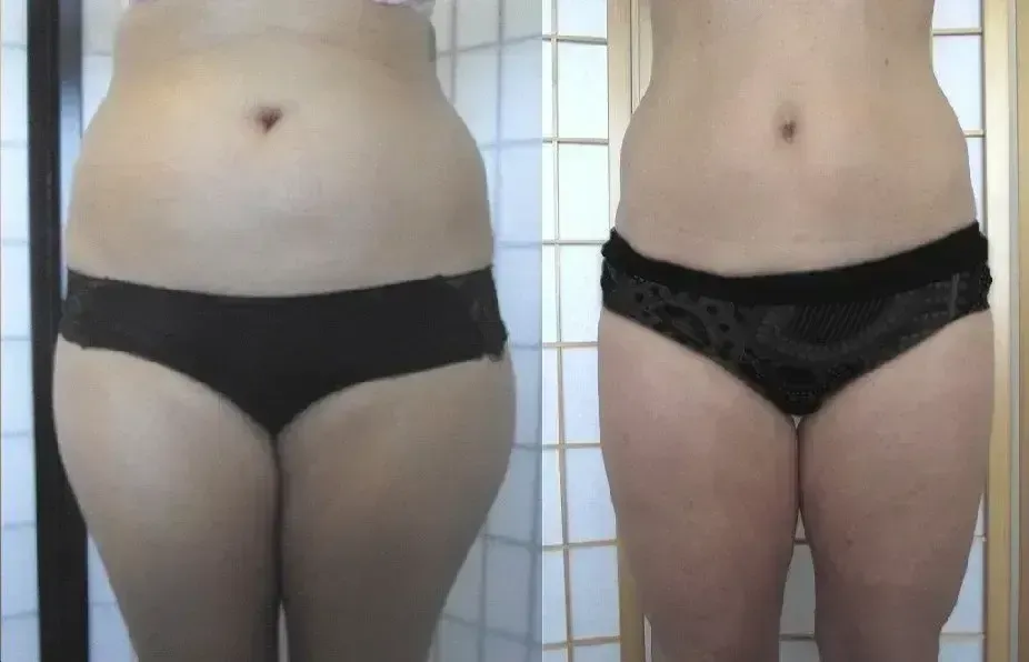 Comparison of a person's abdomen and thighs before and after a change, showing reduced size.