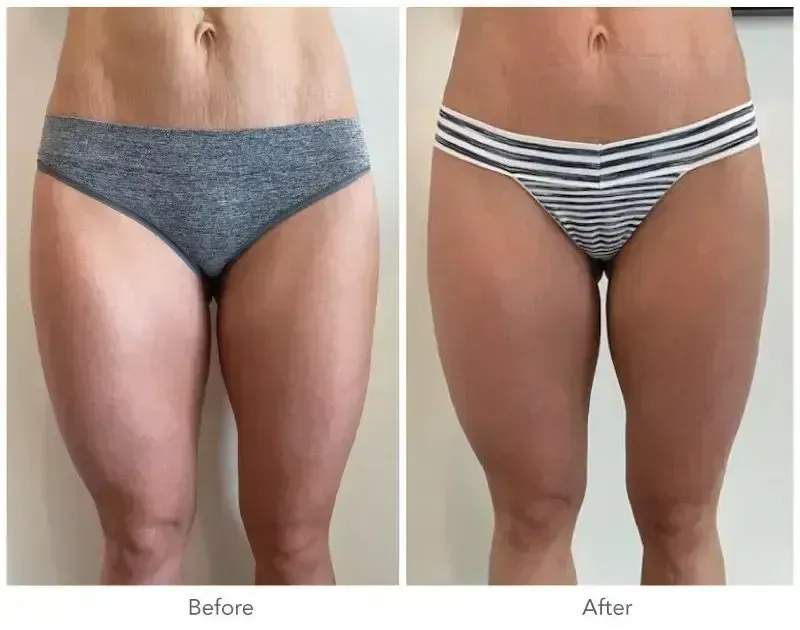 Before and after photos of a person's thighs. Left side: gray underwear. Right side: striped underwear.