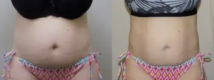 Comparison of a torso with a fuller stomach (left) and a flatter stomach (right), wearing bikini tops and bottoms.